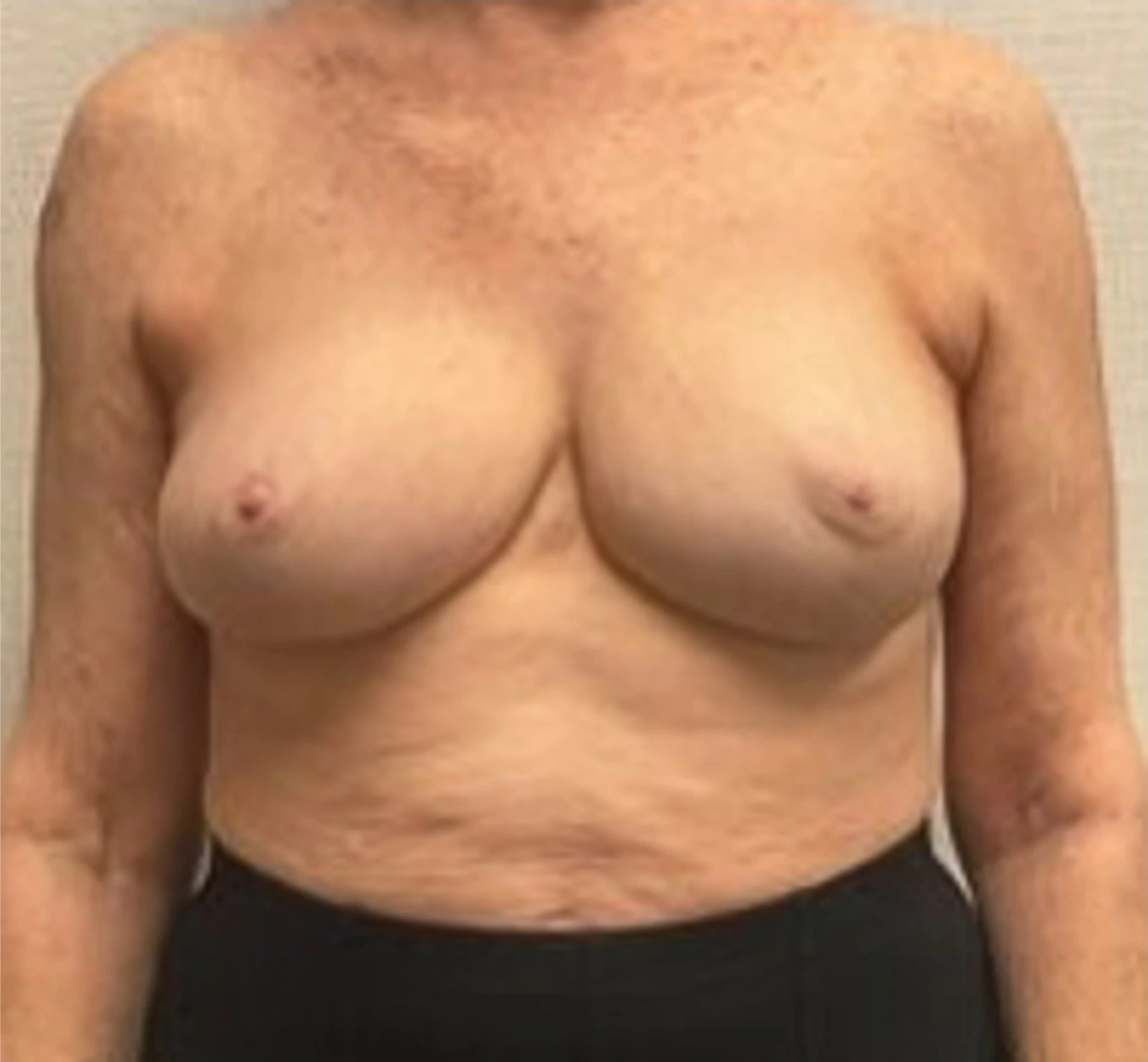 Breast-Reconstruction-Case--24804 | After Breast Reconstruction 1