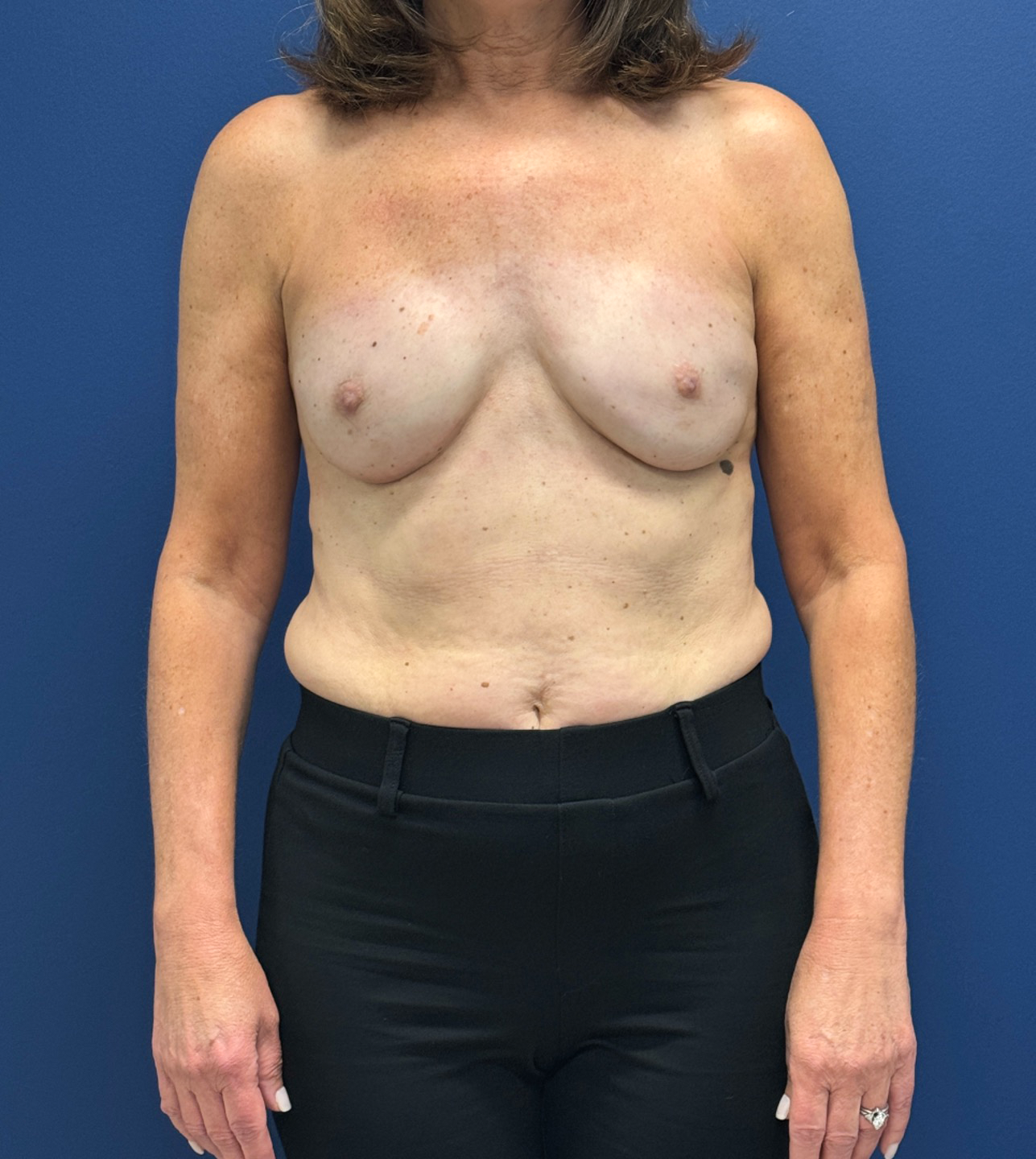 Breast-Reconstruction-Case--28688 | After Breast Reconstruction 1