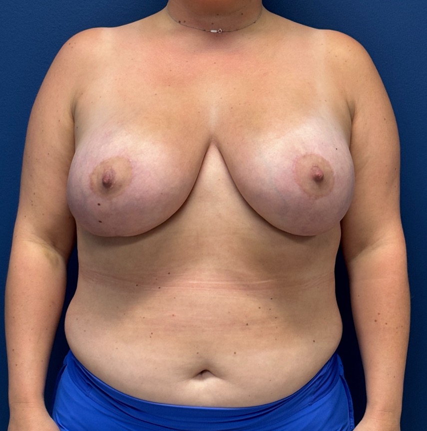 Breast-Augmentation-Mastopexy-Case--29079 | After Dr. Samir Rao 1