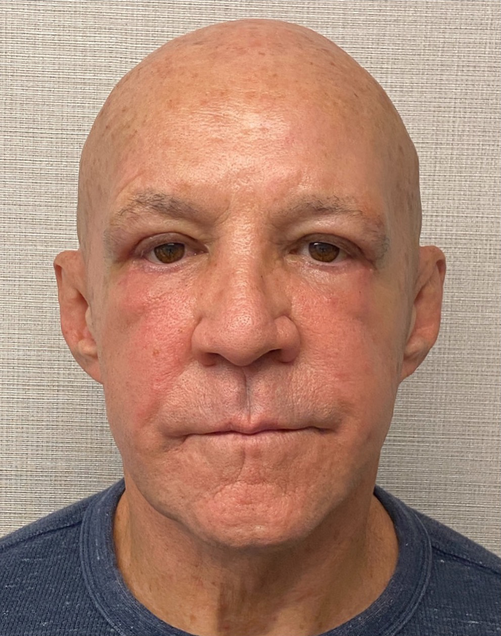 Blepharoplasty-Case--24169 | After Dr. Arjun Kanuri 2