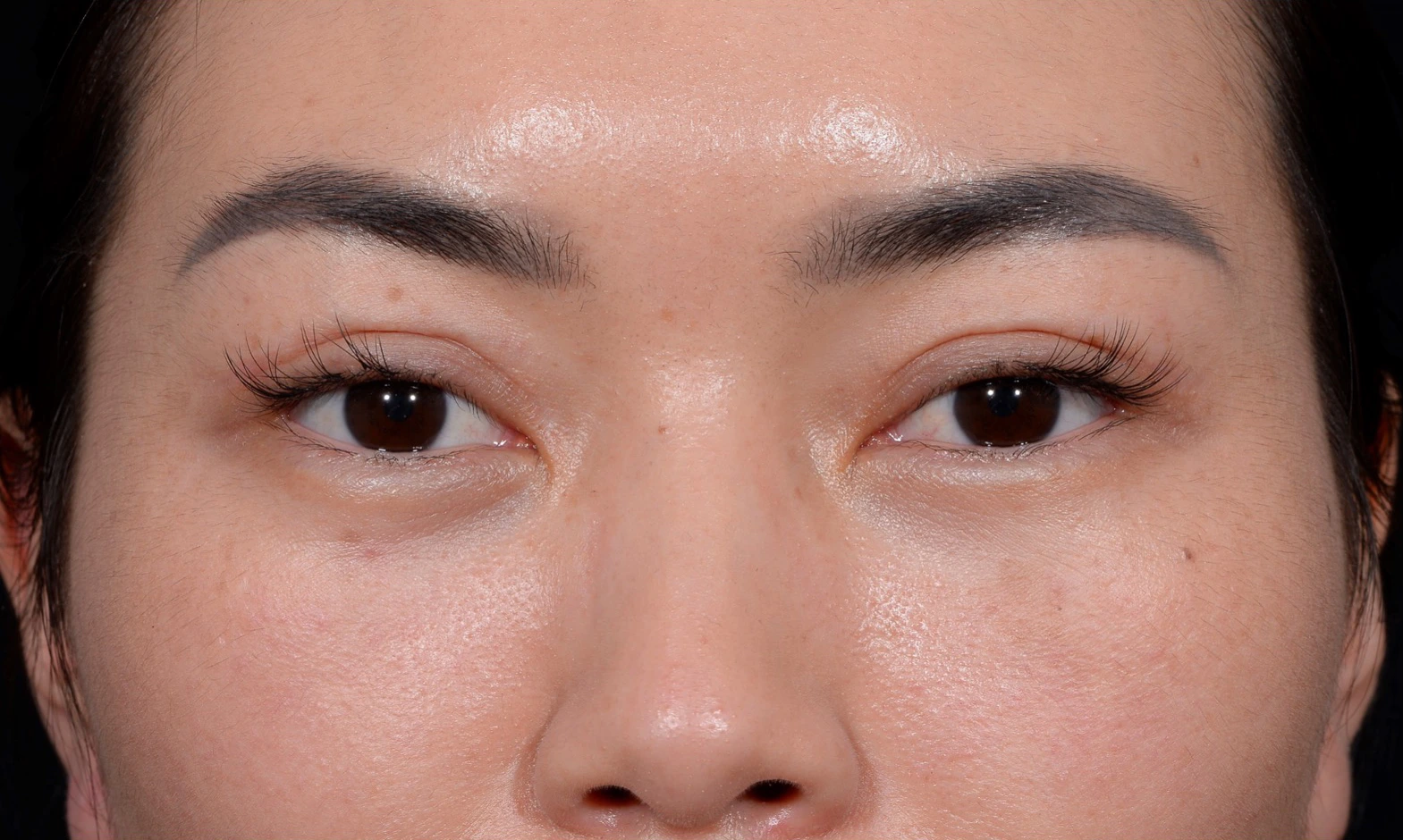Blepharoplasty-Case--356 | After Eyelid Surgery 1