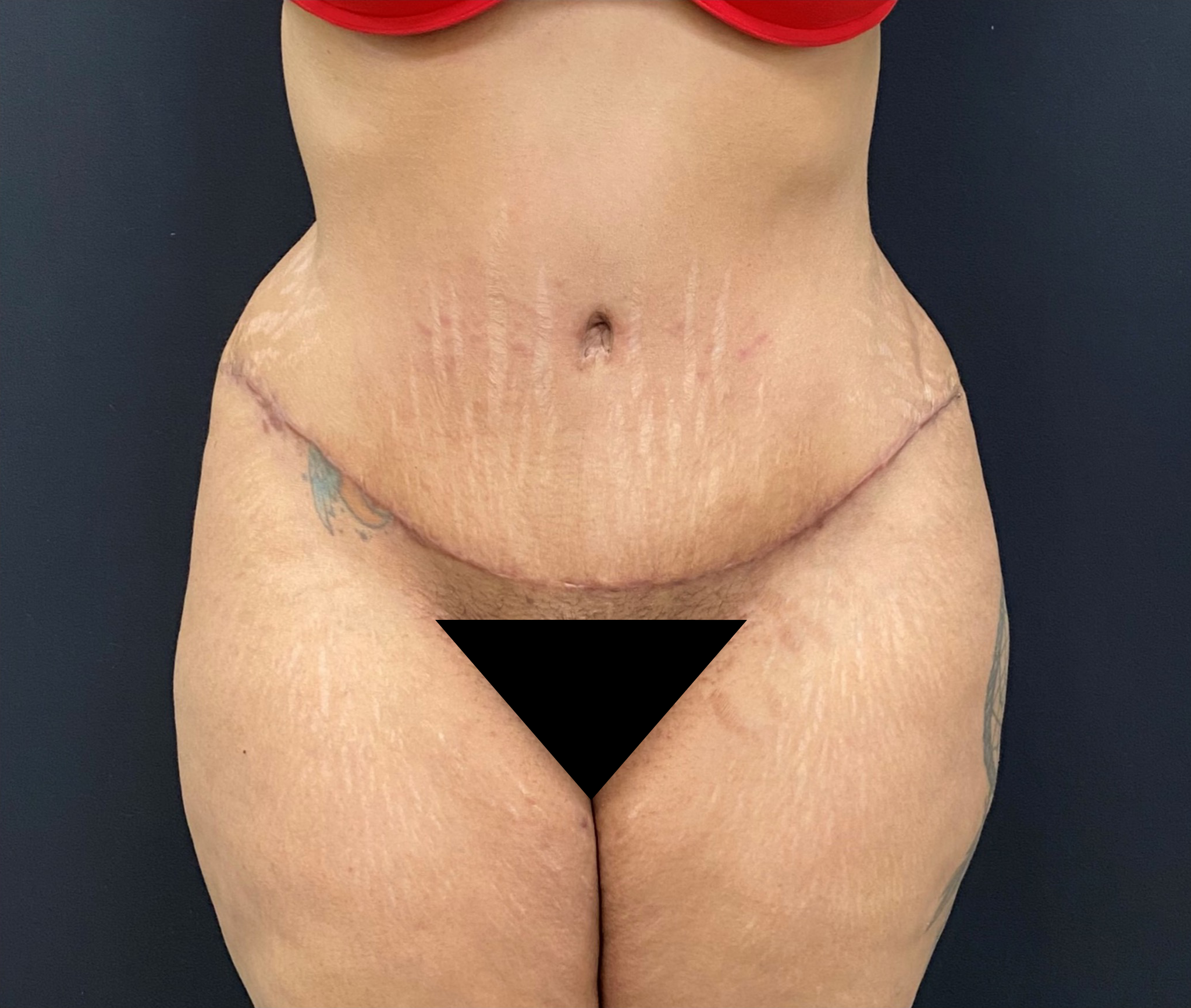 Liposuction-Tummy-Tuck-Case--338 | After Dr. Arjun Kanuri 1