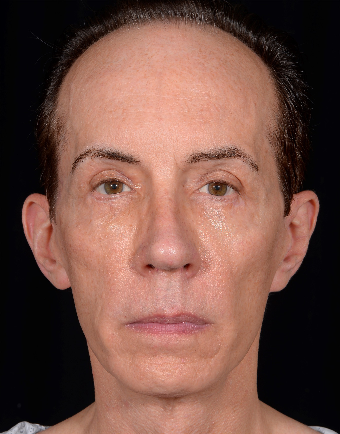 Quad-Blepharoplasty-Case--357 | After Face 1