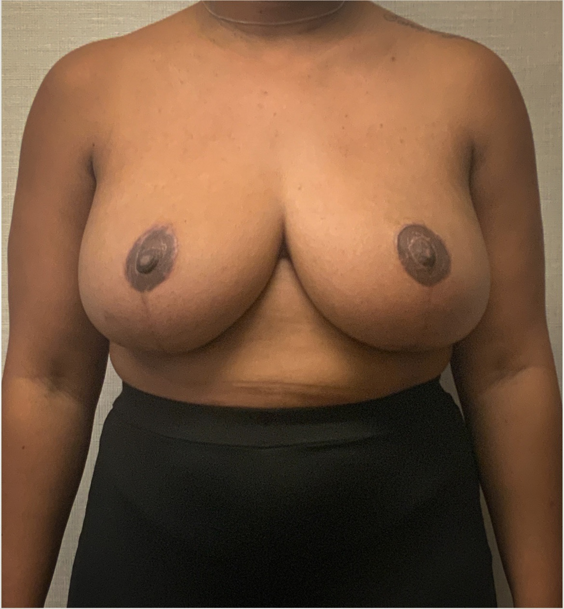 Breast-Reduction-Case--2564 | After Dr. Arjun Kanuri 1