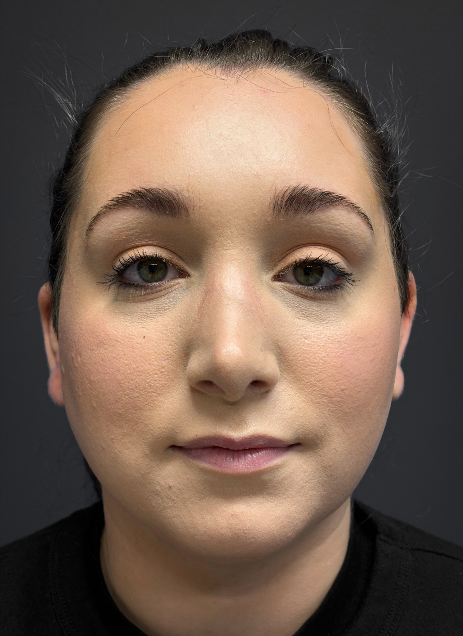 Submental-Liposuction-Case--3439 | After Face 1