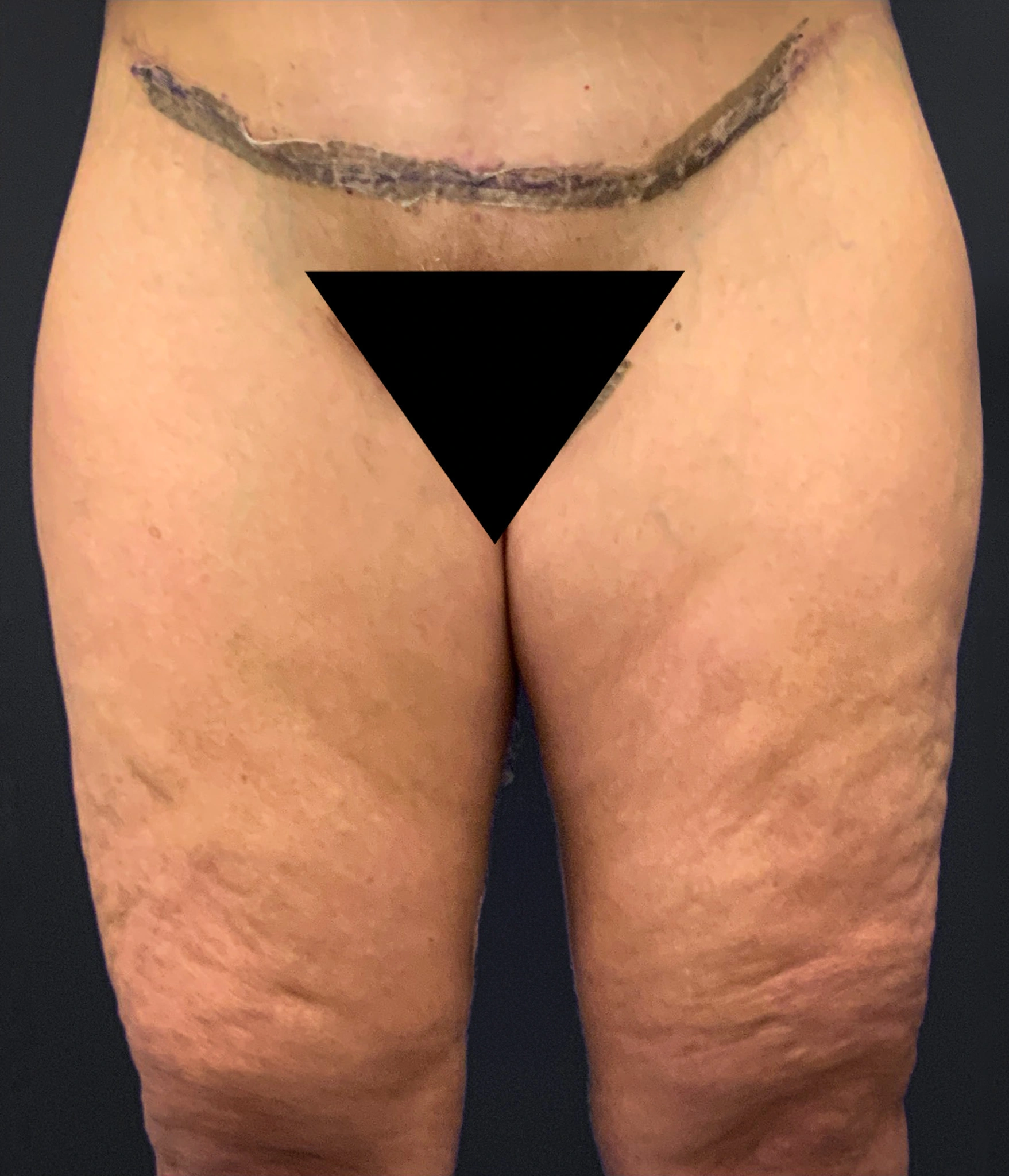 Thighplasty-Case--2024 | After Thigh Lift 1