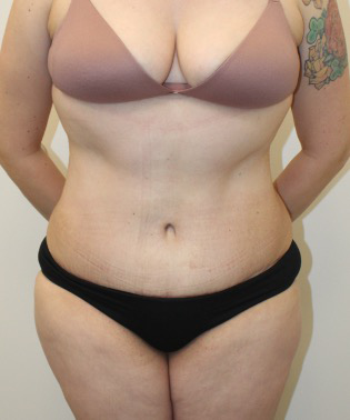 Liposuction-Tummy-Tuck-Case--343 | After Dr. Arjun Kanuri 1