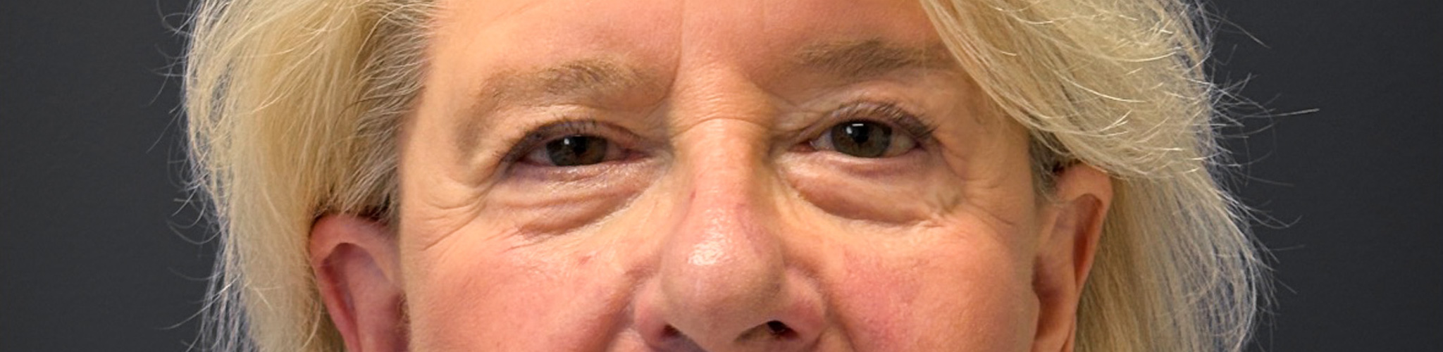 Blepharoplasty-Case--3336 | After Dr. Arjun Kanuri 1