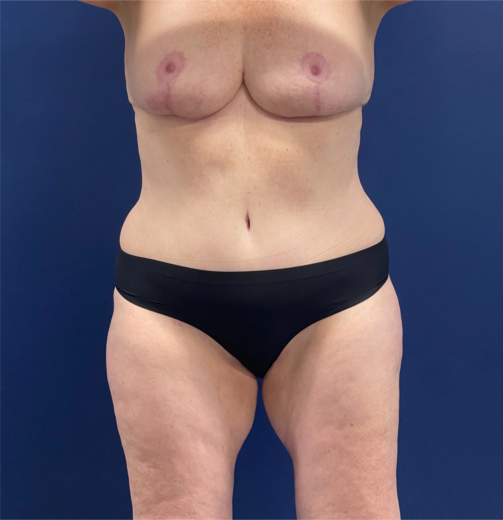 Mommy-Makeover-Case--26853 | After Body 1
