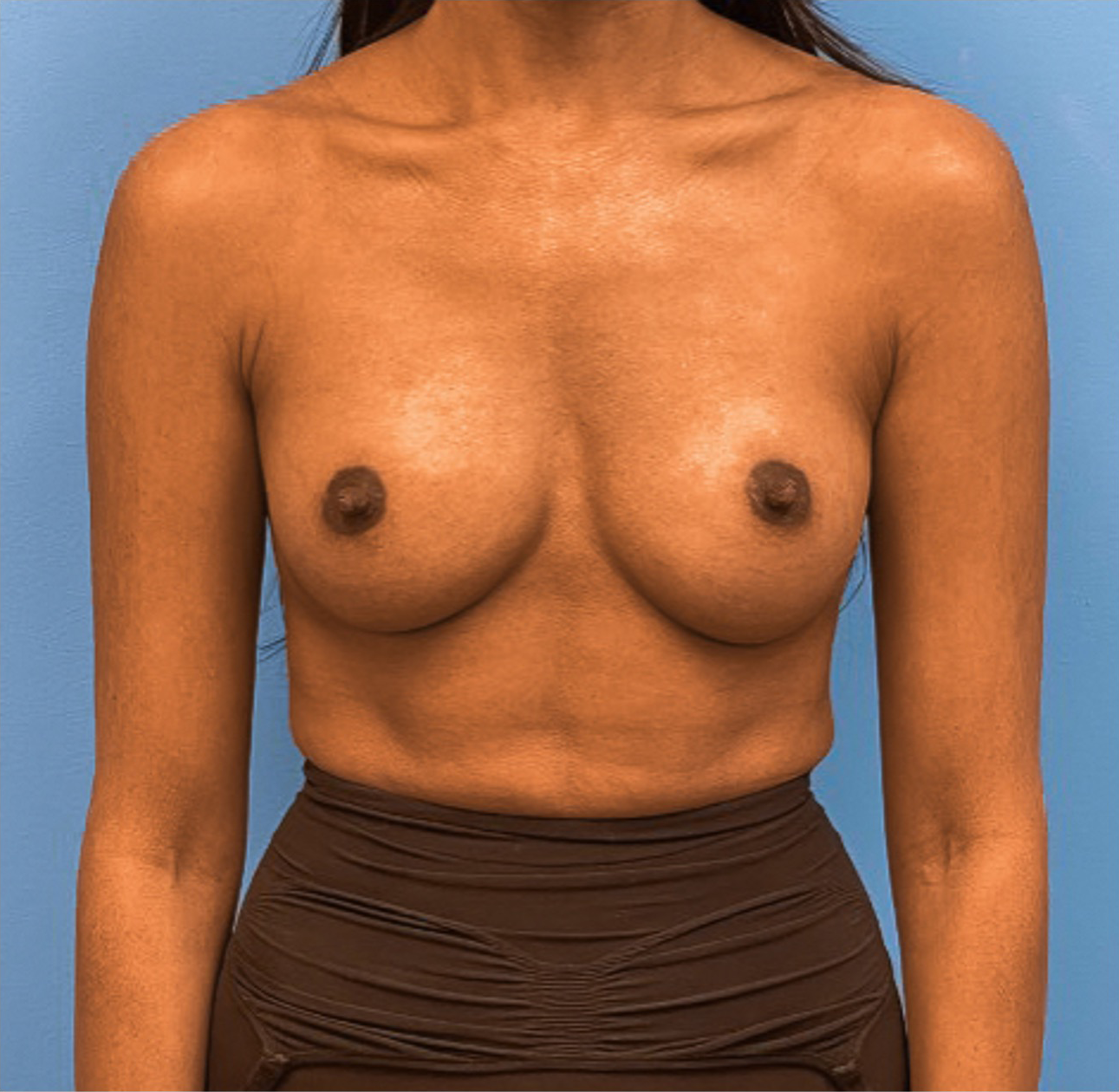 Breast-Augmentation-Case--25592 | After Dr. Samir Rao 1
