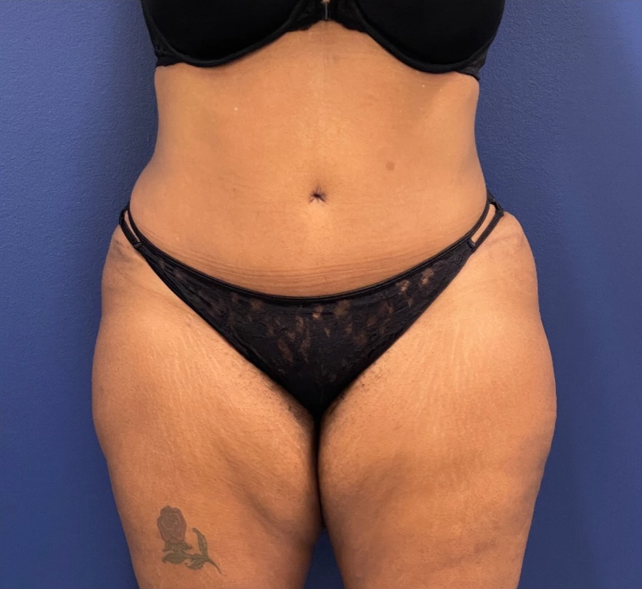 Lipoabdominoplasty-Case--245 | After Dr. Samir Rao 1