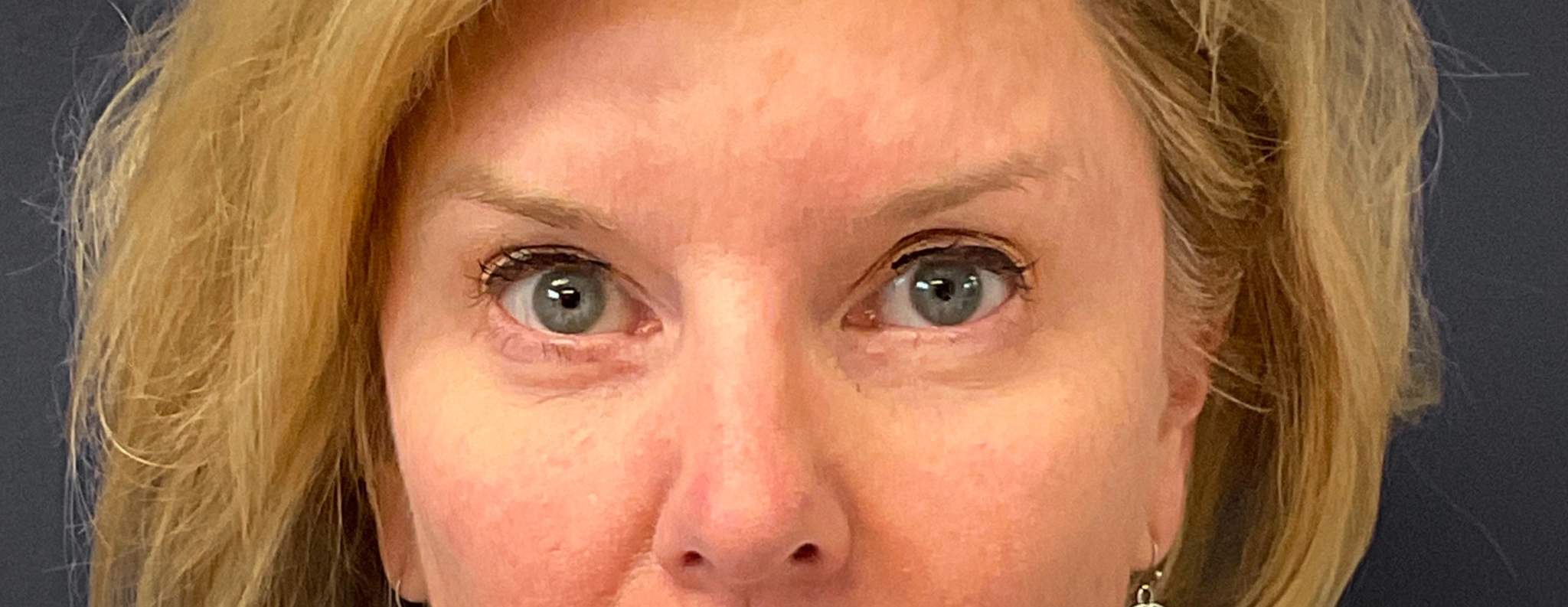 Blepharoplasty-Case--7015 | After Dr. Arjun Kanuri 1