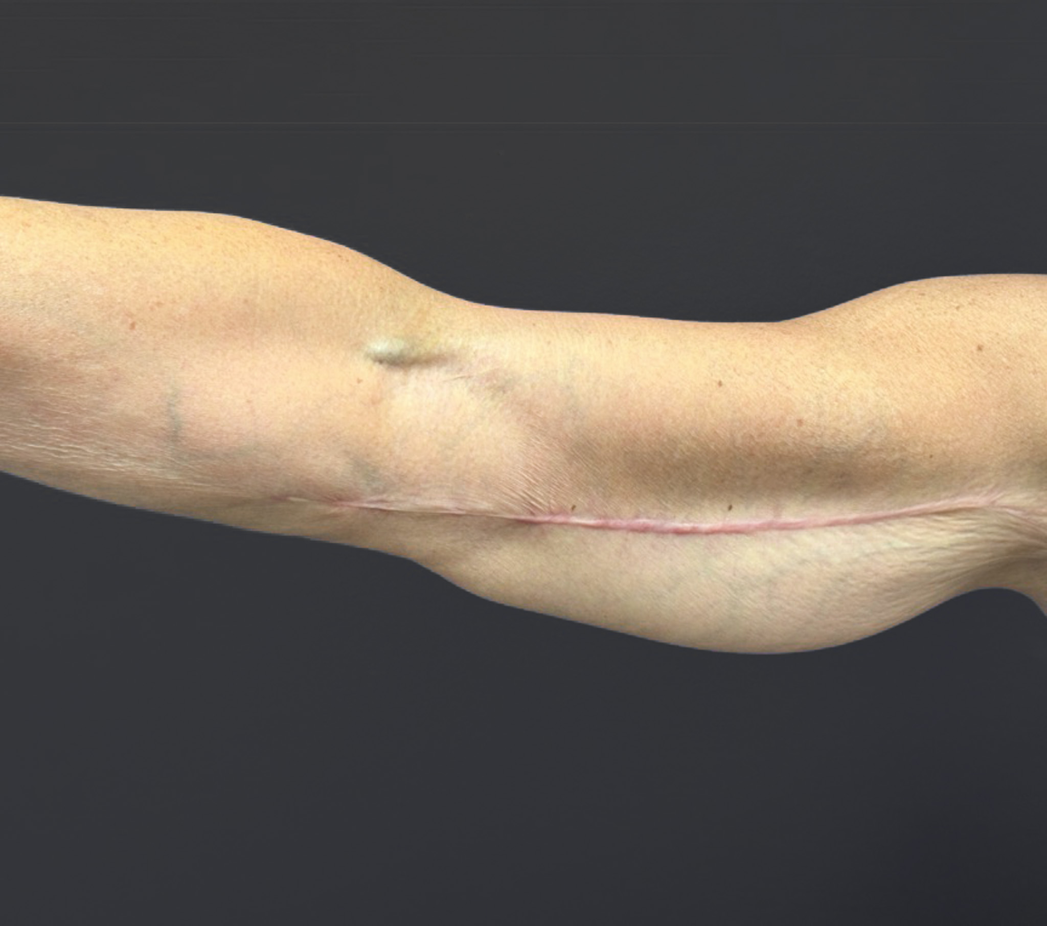 Brachioplasty-Case--6382 | After Arm Lift 6