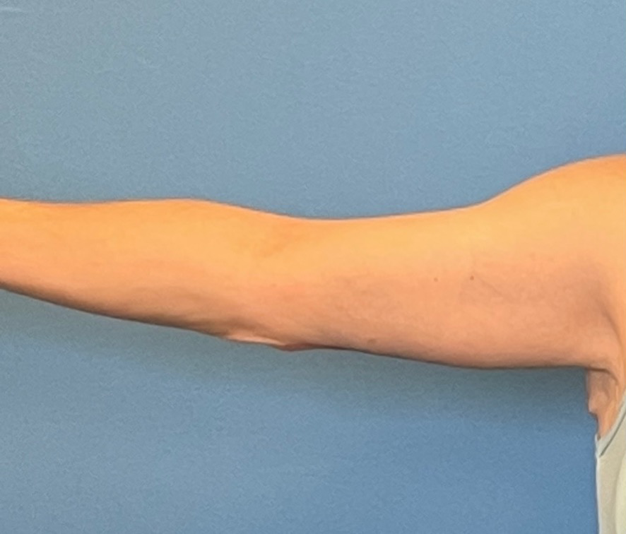 Brachioplasty-Arm-Lift-Case--18182 | After Arm Lift 1
