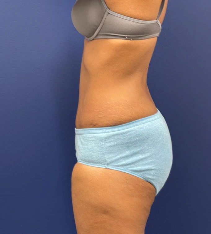 Abdominoplasty-Case--24922 | After Dr. Samir Rao 2