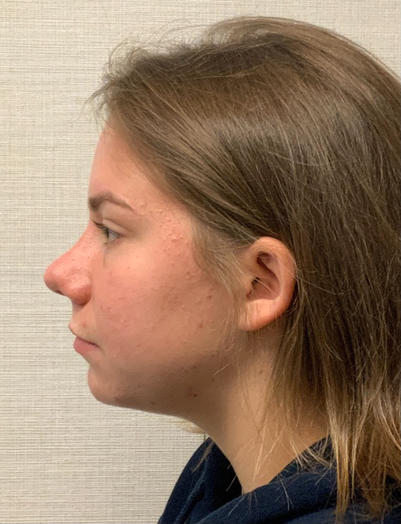 Rhinoplasty-Septoplasty-Case--23611 | After Dr. Arjun Kanuri 1