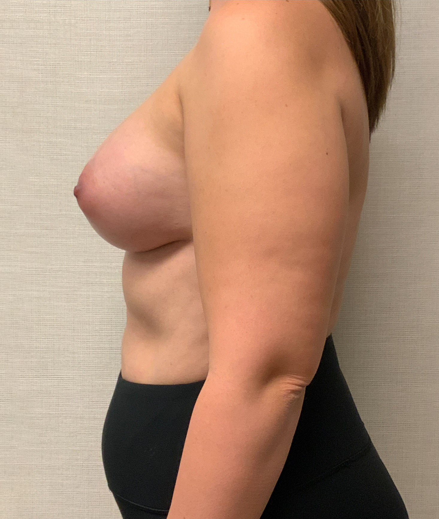 After Breast Augmentation (Left)