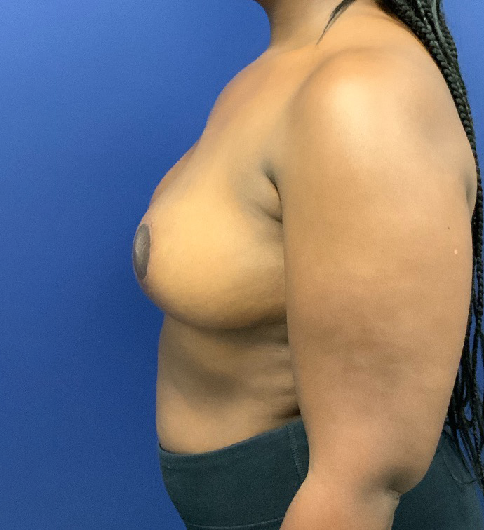 Breast-Reduction-Case--27530 | After Breast Reduction 3