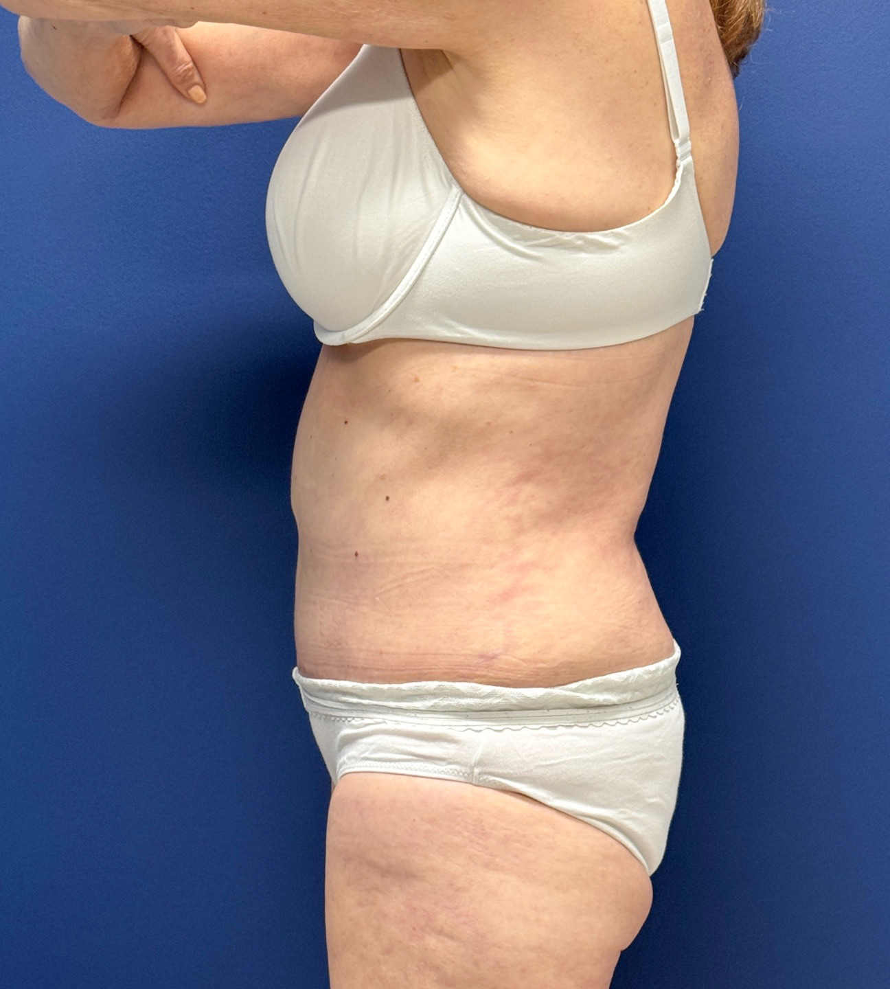 Abdominoplasty-Case--23690 | After Dr. Samir Rao 2