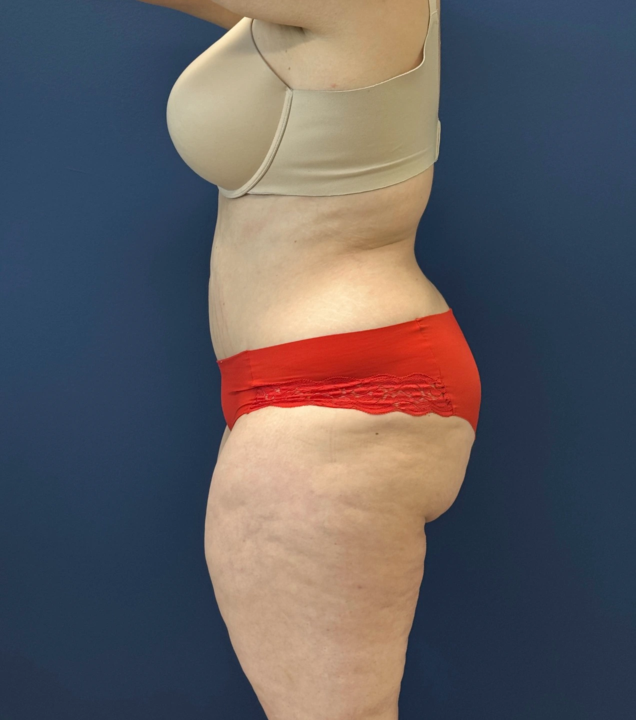 Tummy-Tuck-Case--28426 | After Tummy Tuck 2