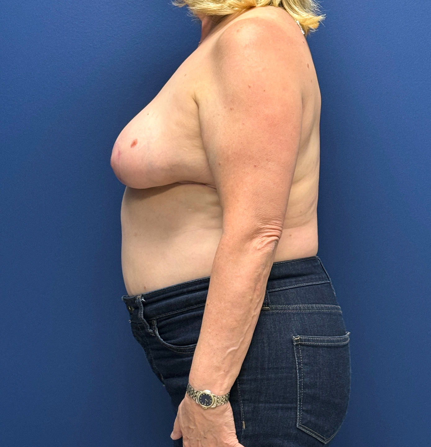 Breast-Reduction-Case--29091 | After Breast Reduction 2