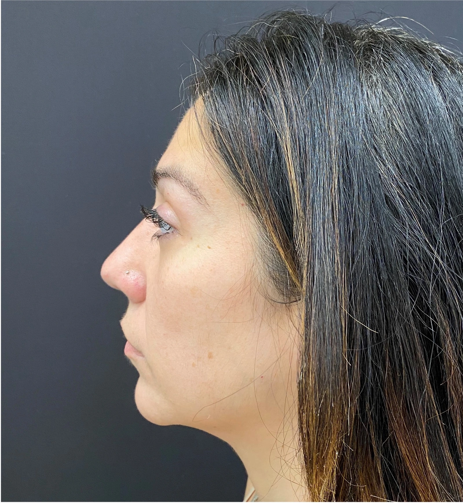 Rhinoplasty-Case--377 | After Face 2
