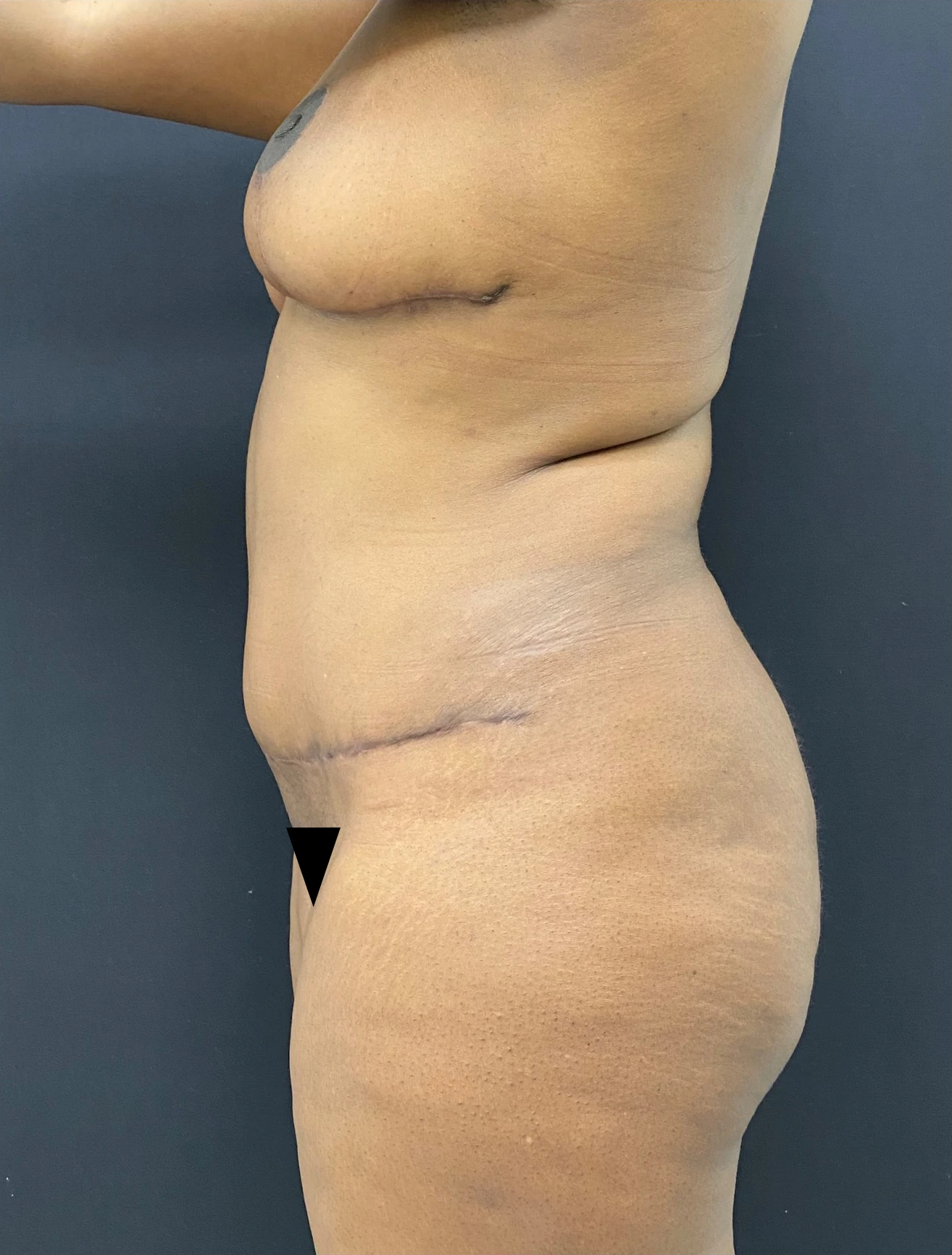 Mommy-makeover-Case--336 | After Body 2