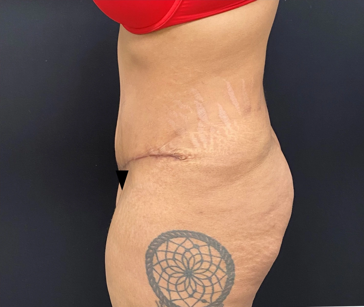 Liposuction-Tummy-Tuck-Case--338 | Before Liposuction 3