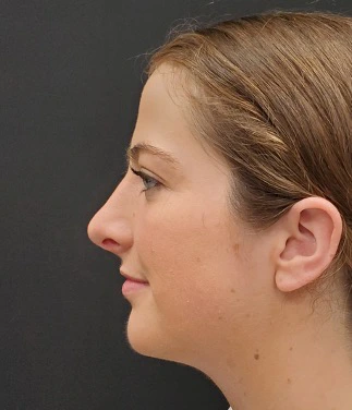 Rhinoplasty-and-Chin-Implant-Case--381 | After Rhinoplasty 3