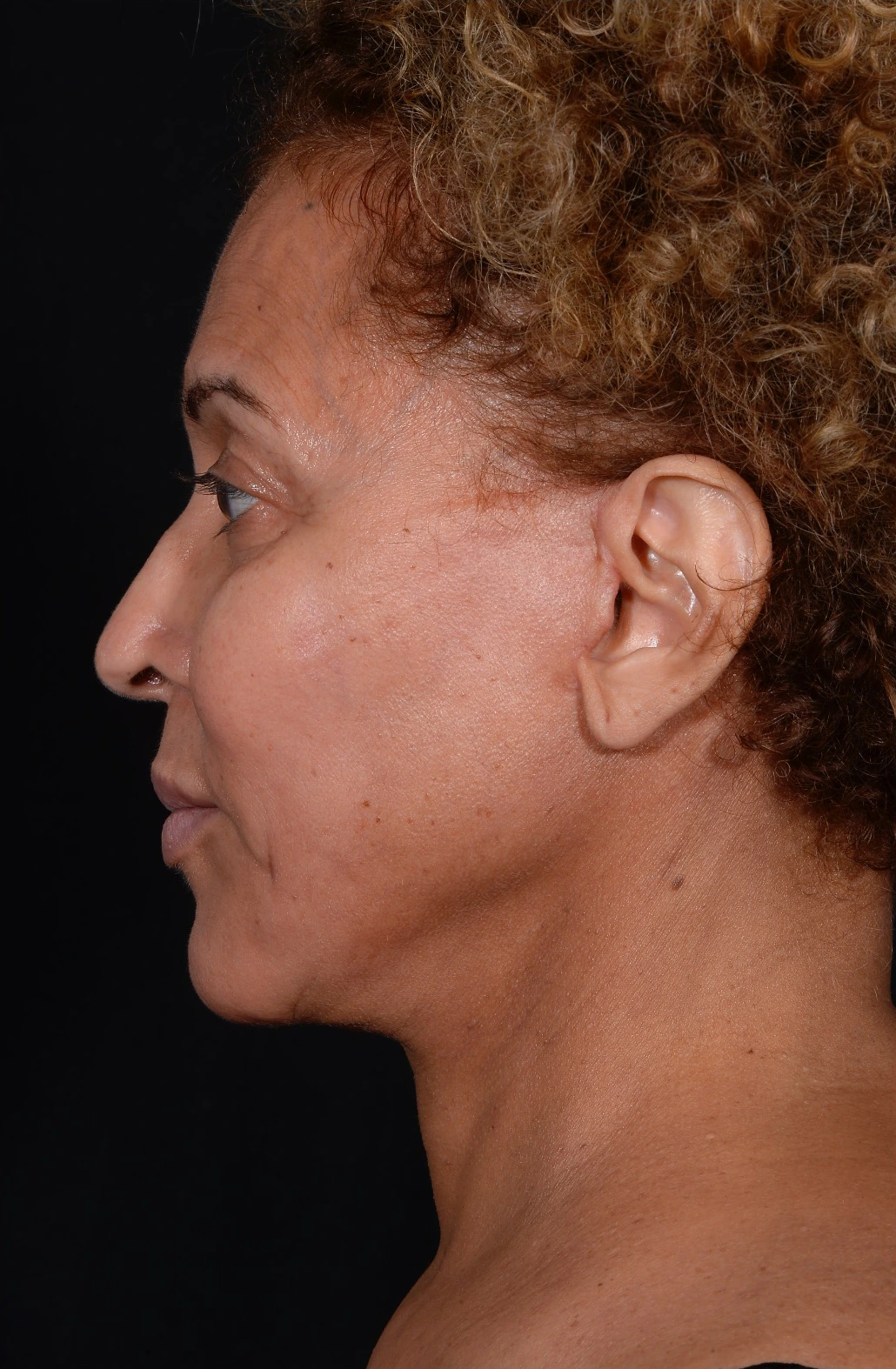 Facelift-Case--360 | After Facelift 3