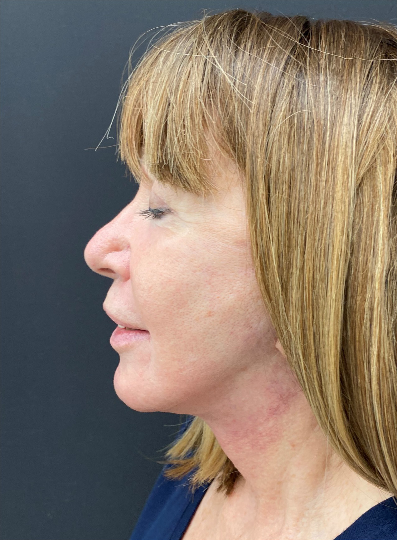 Facelift-Case--365 | After Facelift 3