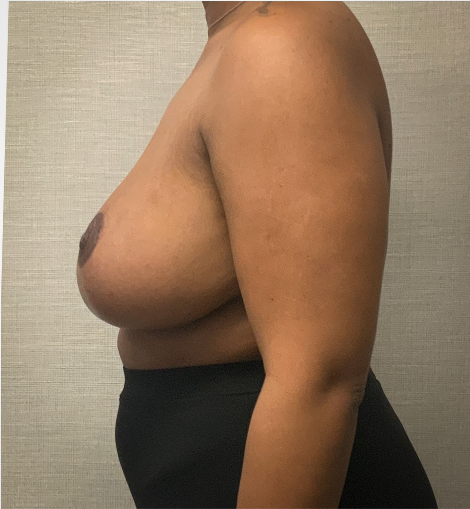 Breast-Reduction-Case--2564 | After Dr. Arjun Kanuri 2