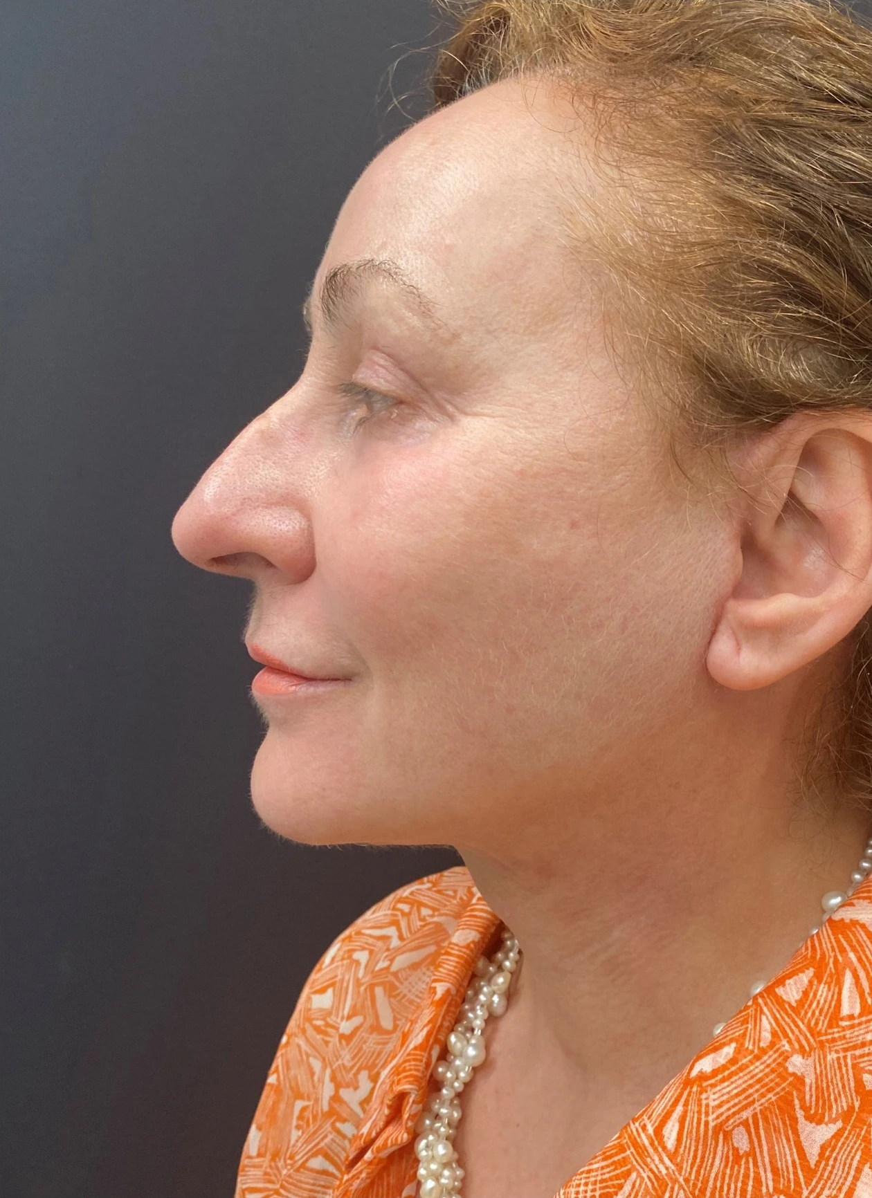 Facelift-Case--363 | After Face 2