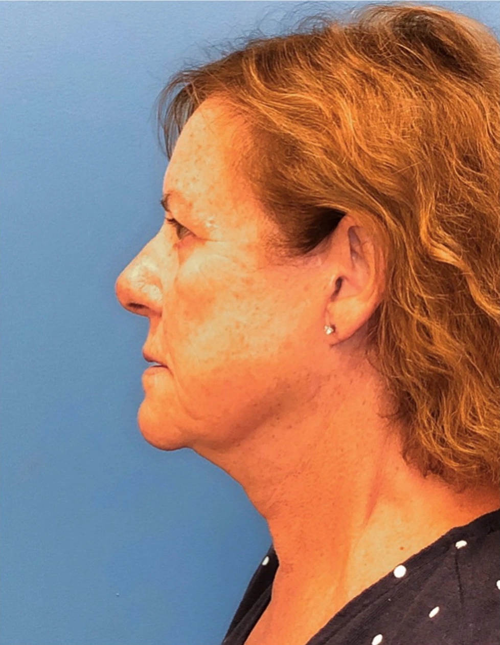 Facelift-Case--14406 | After Eyelid Surgery 3