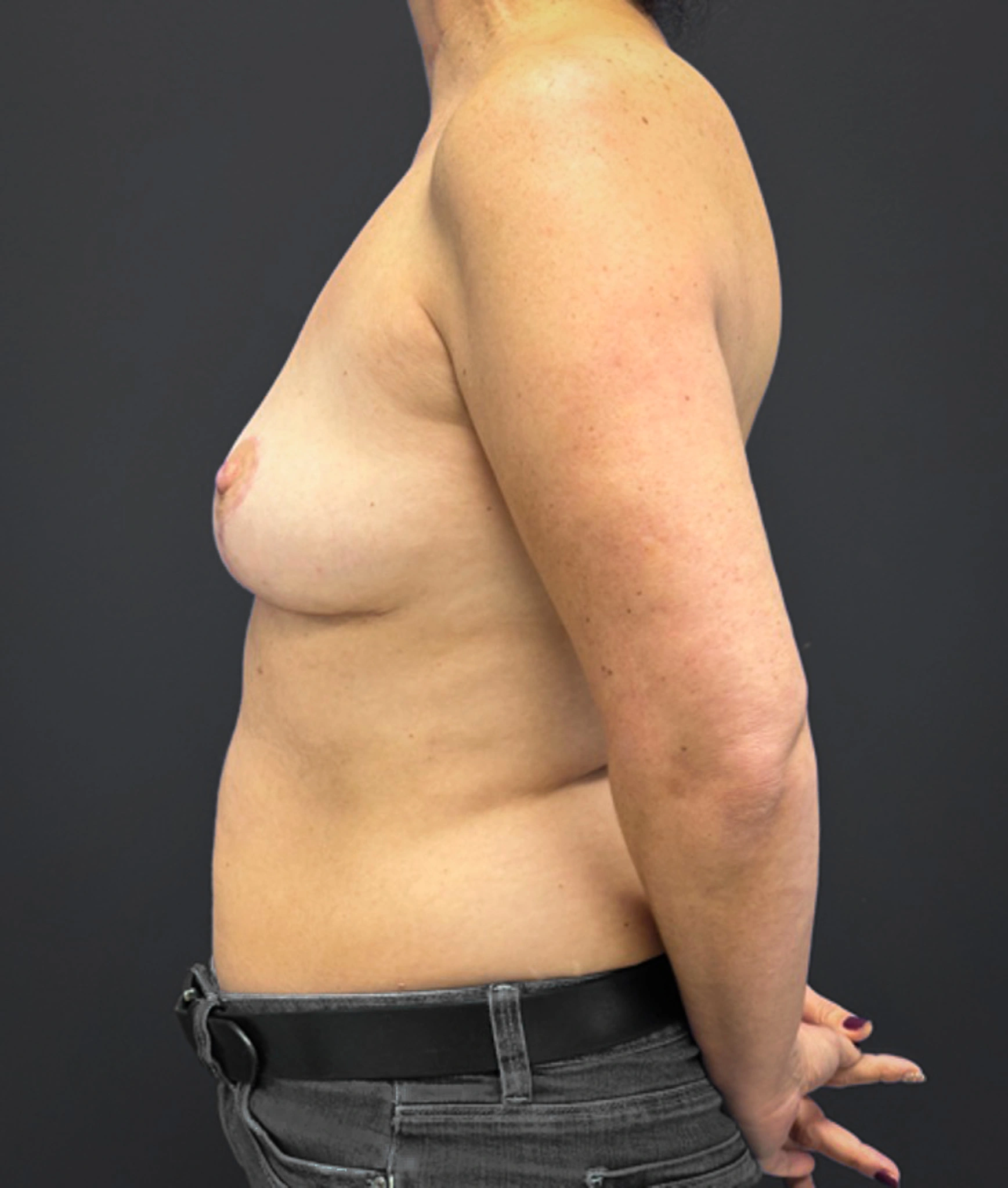 Mastopexy-Case--1663 | After Dr. Frank Albino 2