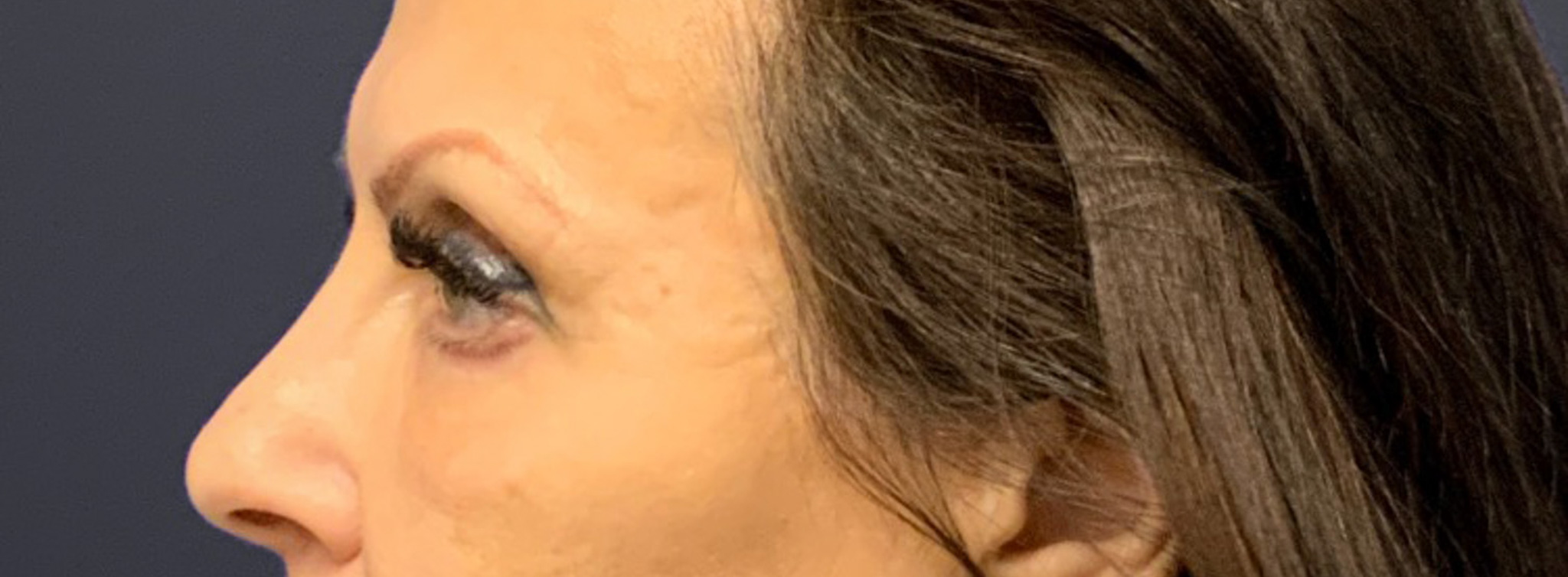 Blepharoplasty-Case--6272 | After Dr. Arjun Kanuri 2
