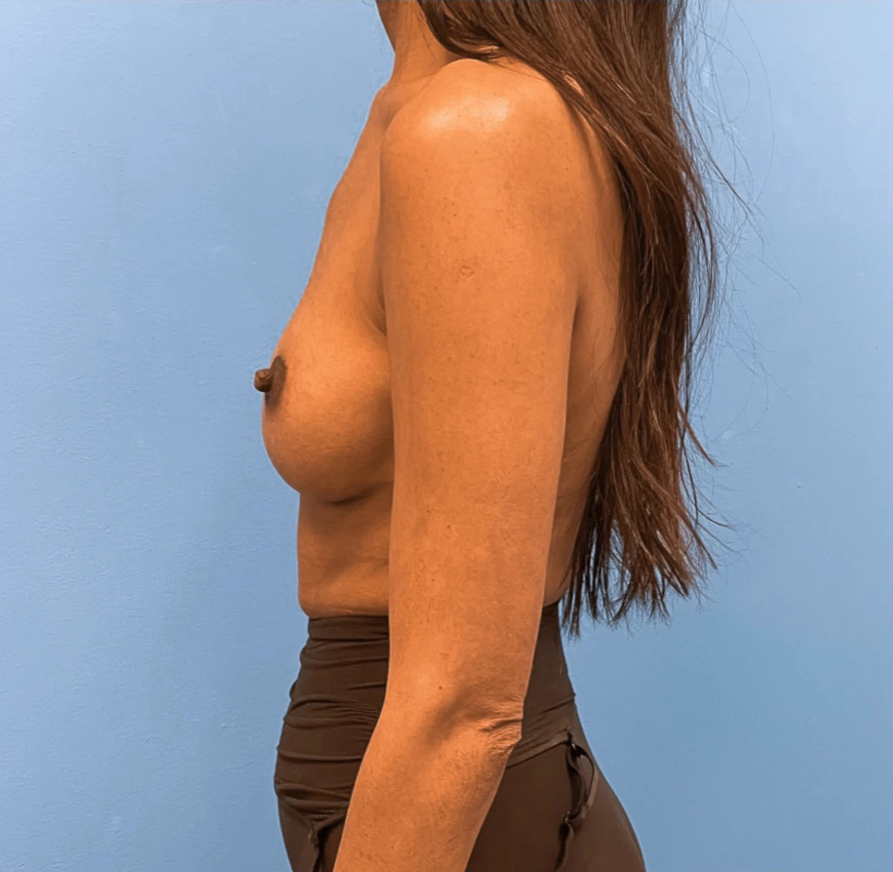 Breast-Augmentation-Case--25592 | After Dr. Samir Rao 2