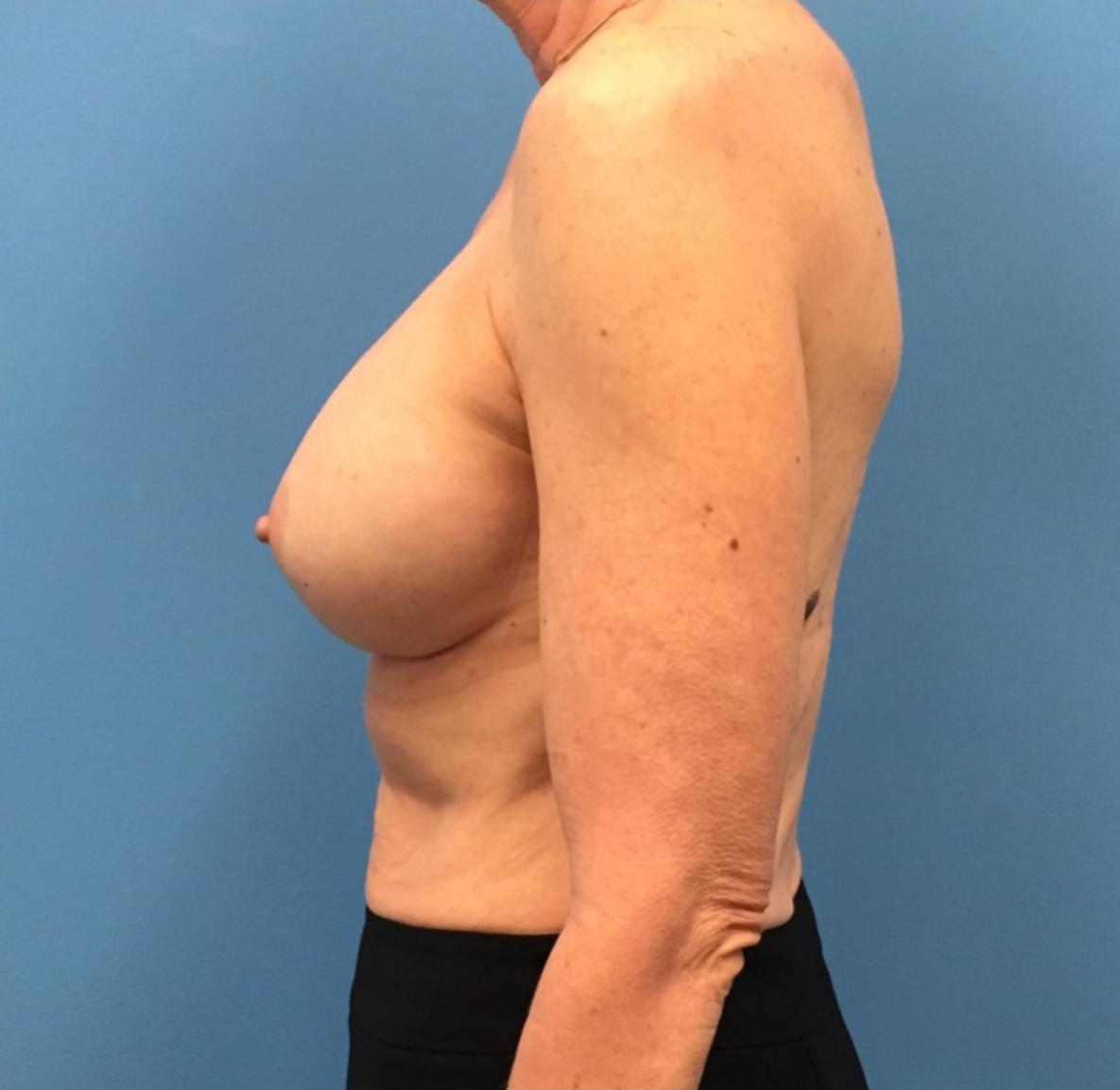 Revision-Breast-Augmentation-Case--237 | After Dr. Samir Rao 2
