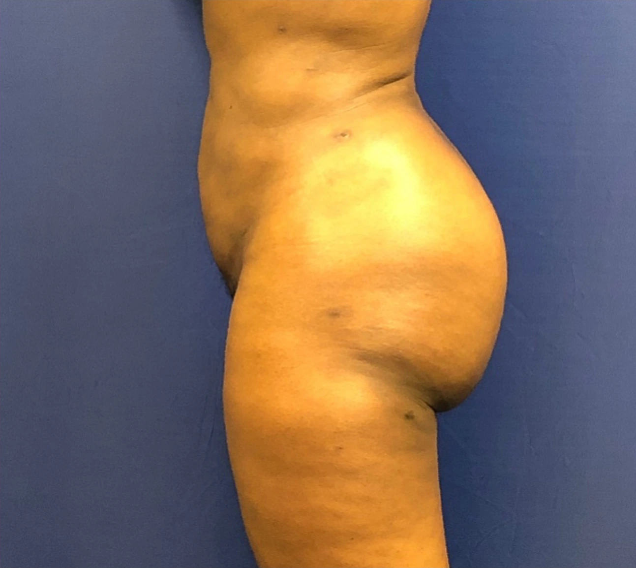 Brazilian-Butt-Lift-Case--267 | After Dr. Samir Rao 2