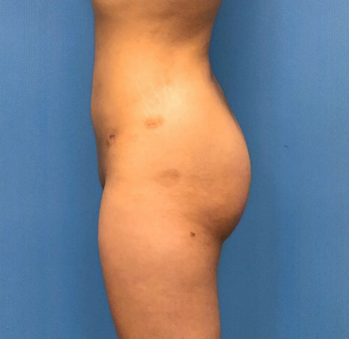 Brazilian-Butt-Lift-Case--268 | After Brazilian Butt Lift 3