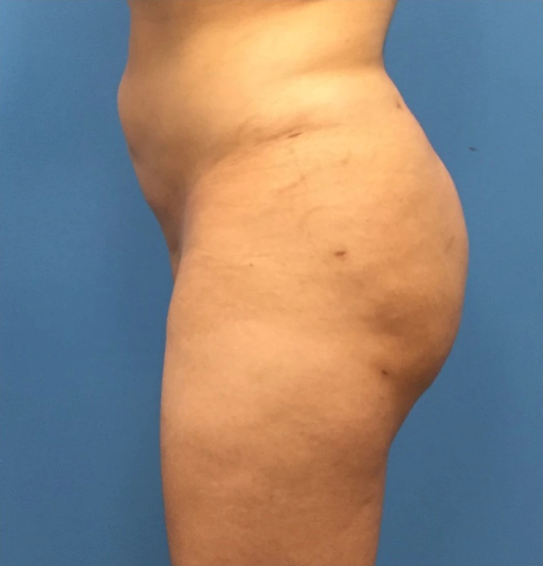 Brazilian-Butt-Lift-Case--272 | After Brazilian Butt Lift 4