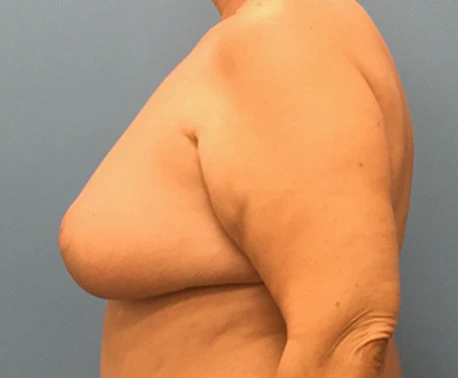 Breast-Reduction-Case--130 | After Breast Reduction 2