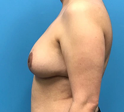 Breast-Reduction-Case--132 | After Breast Reduction 2