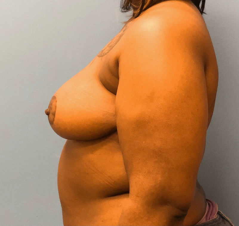 Breast-Reduction-Case--13002 | After Breast Reduction 2