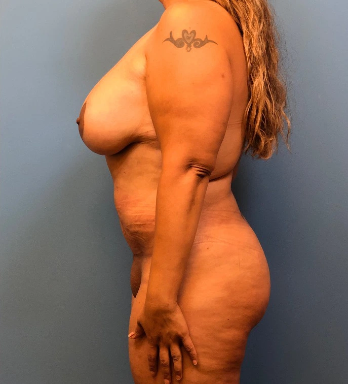 Lipoabdominoplasty-Breast-Augmentation-Case--15133 | After Dr. Samir Rao 2