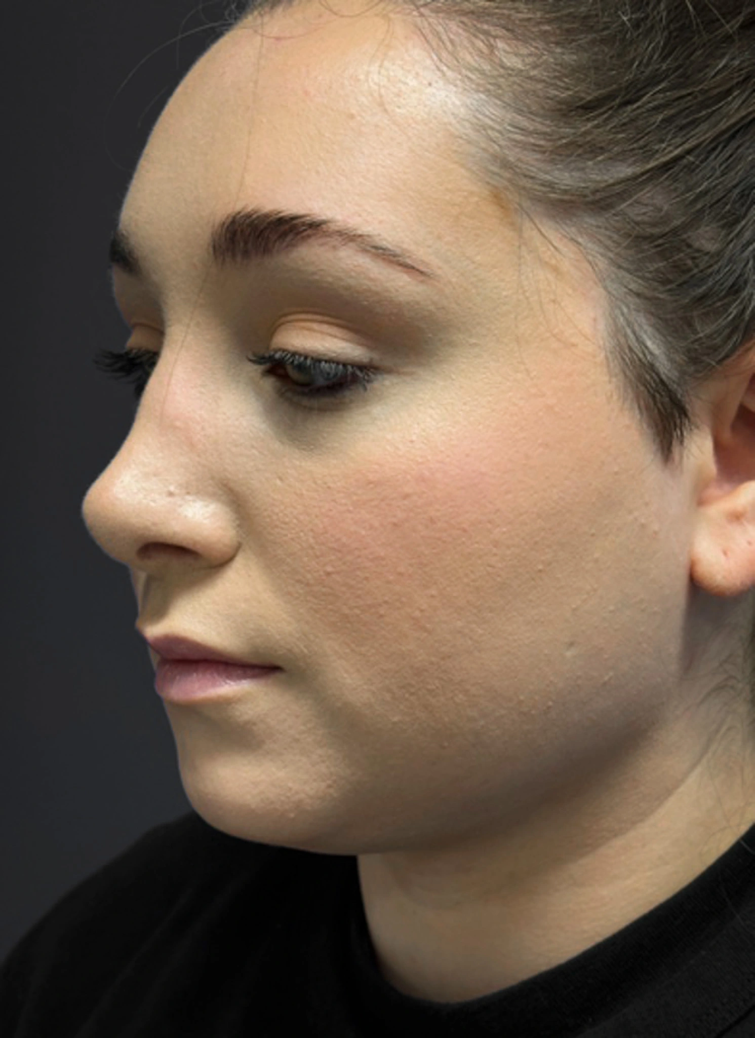 Submental-Liposuction-Case--3439 | After Submental Liposuction 5