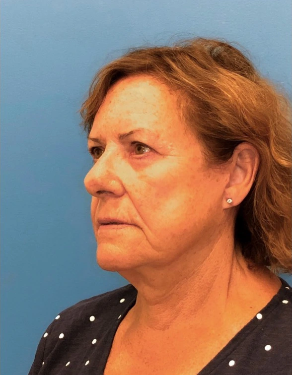 Facelift-Case--14406 | After Dr. Samir Rao 2