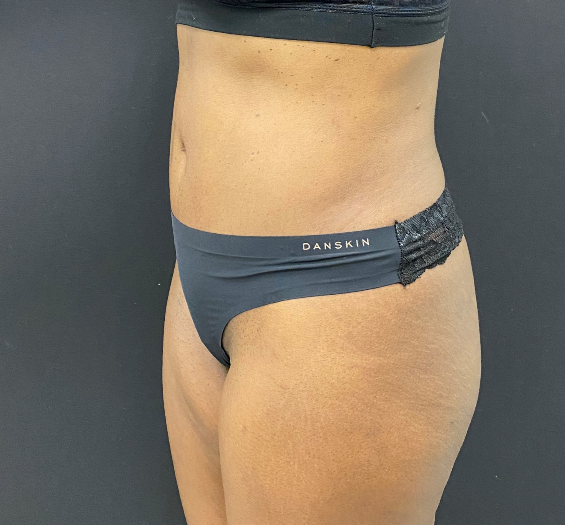 Abdominoplasty-Case--340 | After Body 2