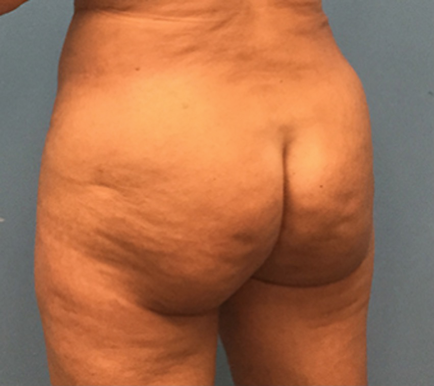Brazilian-Butt-Lift-Case--74 | After Brazilian Butt Lift 3