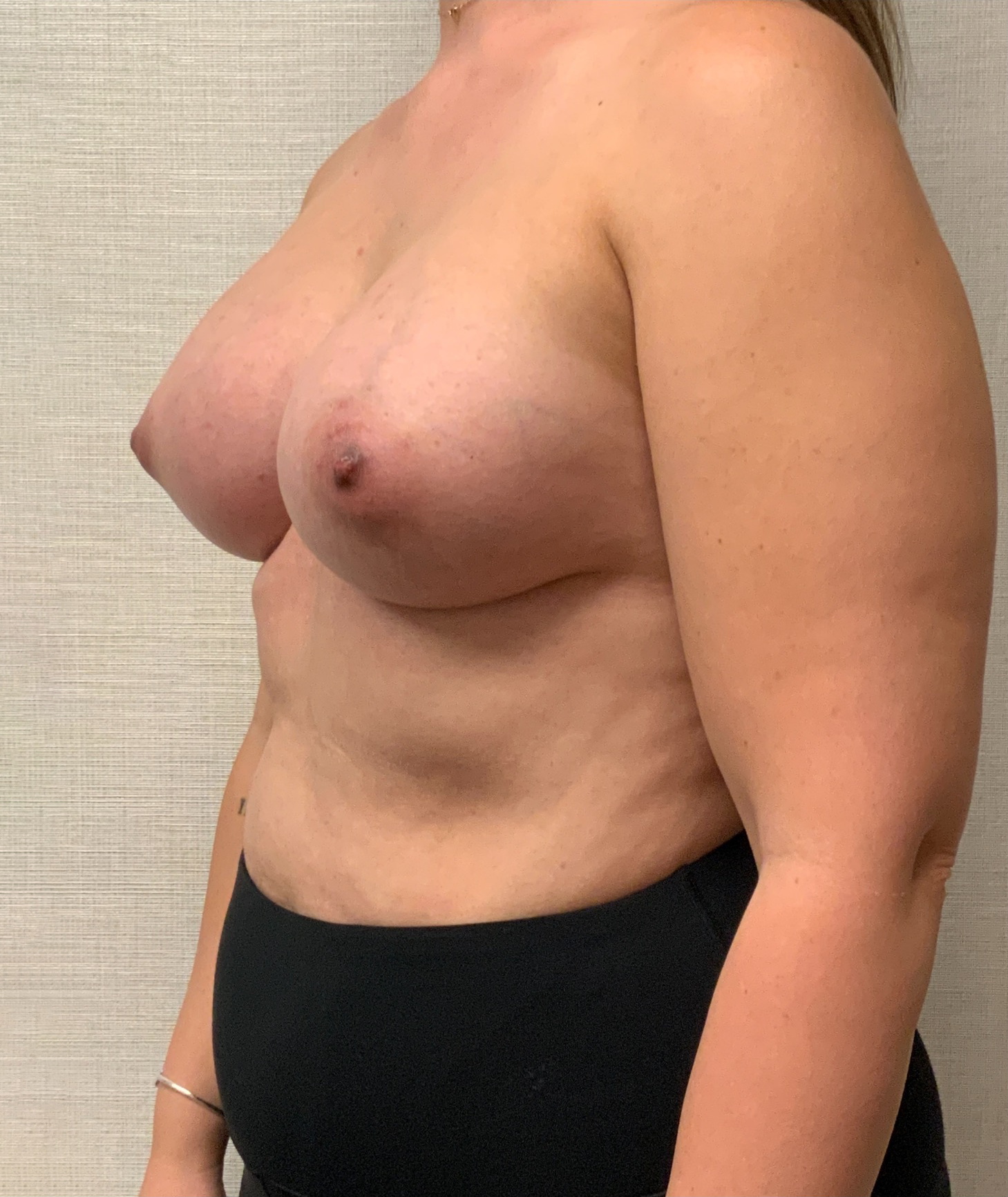 After Breast Augmentation (Left Oblique)